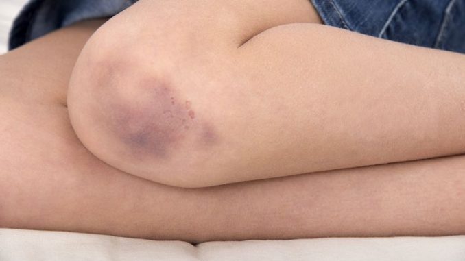 Tři jednoduché tipy, jak se rychle zbavit modřin